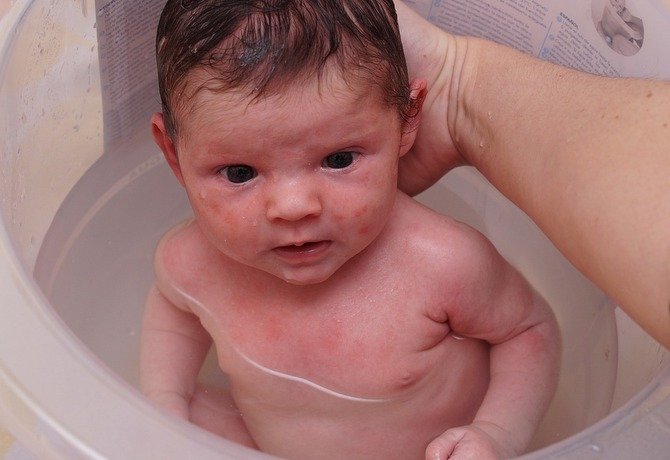 こども ニュージーランド 赤ちゃんの脂漏性湿疹と髪の毛